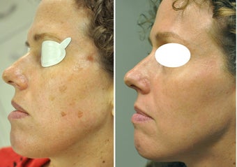 Nd:YAG laser for sunspots