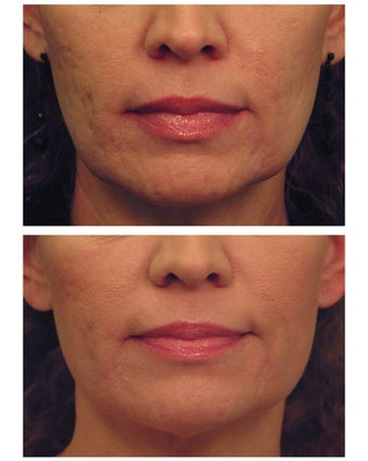 YAG Laser Skin Tightening
