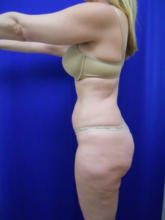 Zerona 
