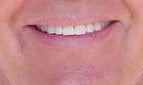 Zoom whitening