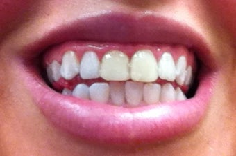 Zoom Whitening
