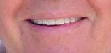 Zoom whitening