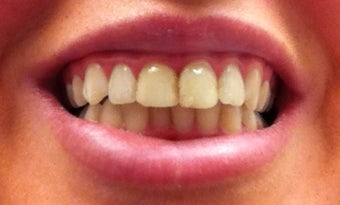 Zoom Whitening