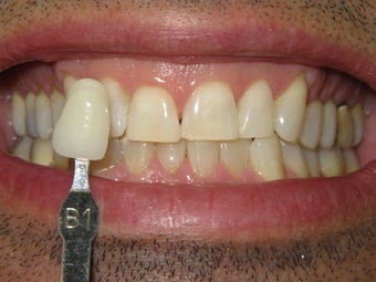 Zoom Whitening