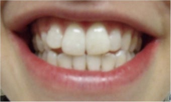 Zoom! Laser Whitening