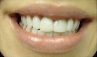 Zoom! Laser Whitening