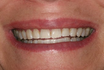 ZOOM whitening
