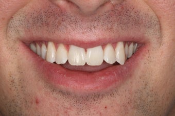 ZOOM whitening