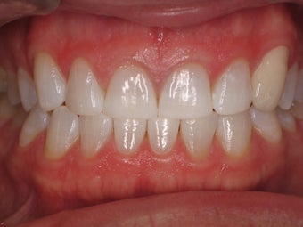 Tooth Whitening