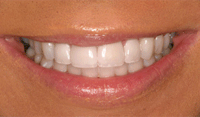 Whitening