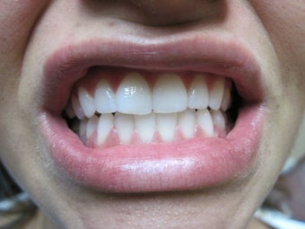 Zoom Teeth Whitening