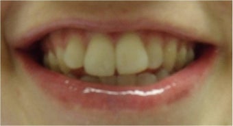 Zoom! Laser Whitening