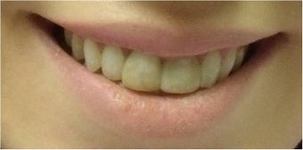 Zoom! Laser Whitening