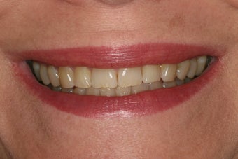 ZOOM whitening