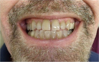 Zoom! Laser Whitening