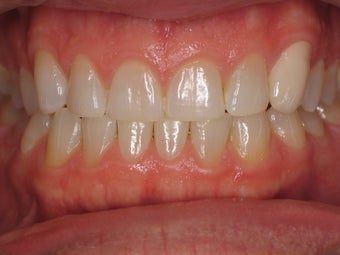 Tooth Whitening