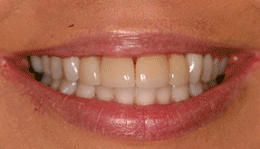 Whitening