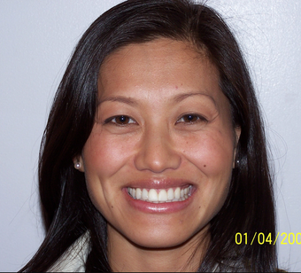 Porcelain Veneers
