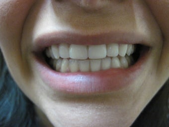 Zoom Teeth Whitening