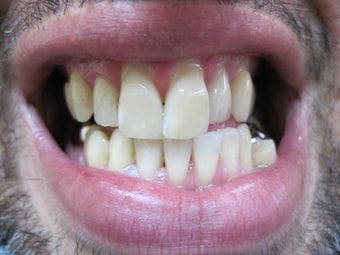 Zoom Teeth Whitening
