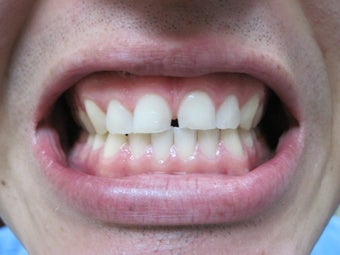 Zoom Teeth Whitening