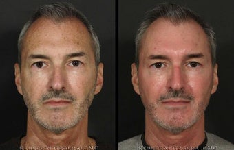 Botox, Obagi for Melasma. eMatrix