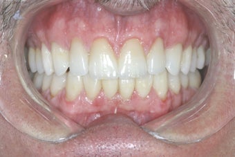 Bites can improve from a full restoration