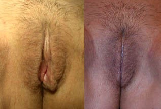 Before & After Labiaplasty Surgery (labia minora reduction) 