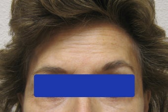 60 year old female treated with Botox for forehead lines
