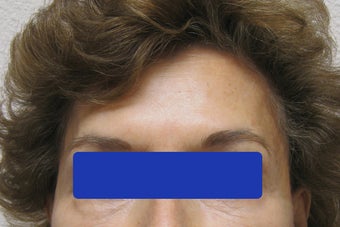 60 year old female treated with Botox for forehead lines