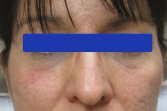 Undereye dark circles treated with filler