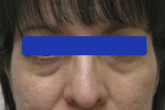 Undereye dark circles treated with filler