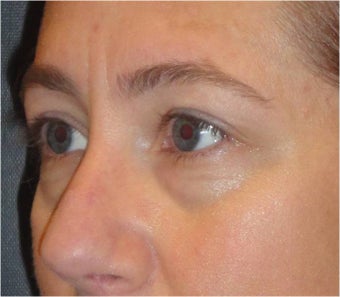 Restylane 