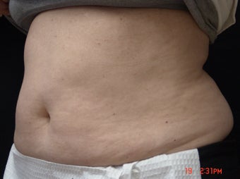 Coolsculpting