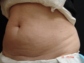 Coolsculpting