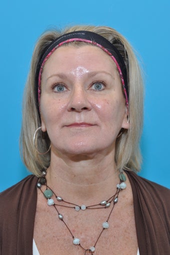60-year-old female for 1st Botox Treatment
