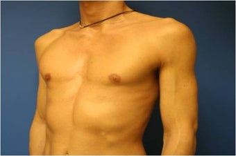 Pectoral Augmentation, Pec Implants