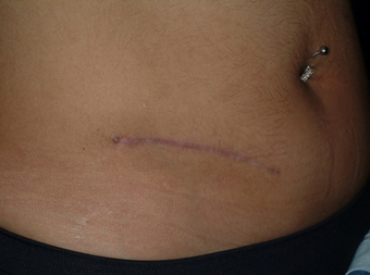 Scar revision of appendectomy scar