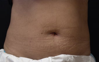 Coolsculpting Abdomen
