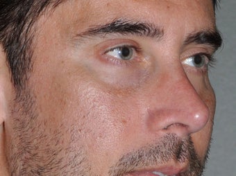 45 Year Old Male Who Desired Stronger Appearing Cheeks