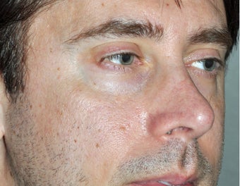 45 Year Old Male Who Desired Stronger Appearing Cheeks