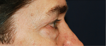 Eye Bag Surgery