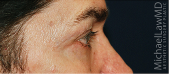 Eye Bag Surgery