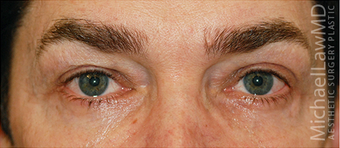 Eye Bag Surgery