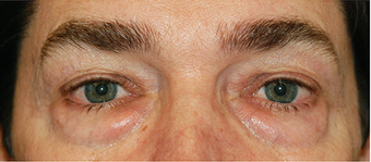 Eye Bag Surgery