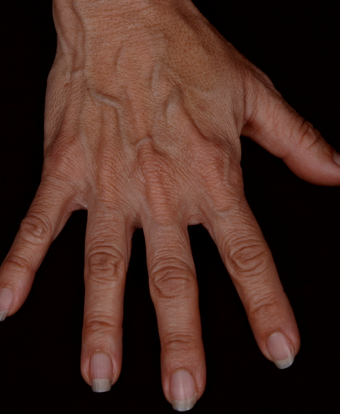Radiesse to Hands