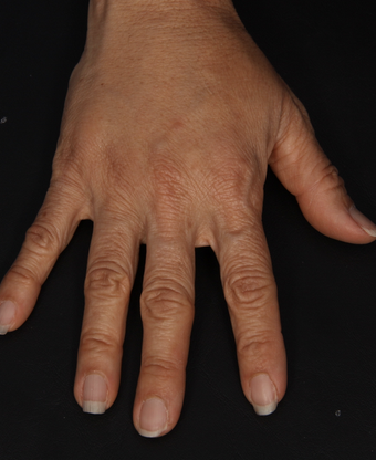 Radiesse to Hands