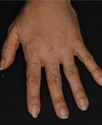 Radiesse to Hands