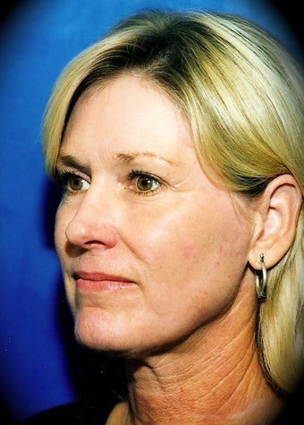 Laser Skin Resurfacing