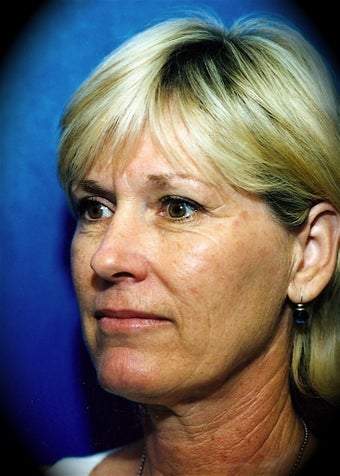 Laser Skin Resurfacing